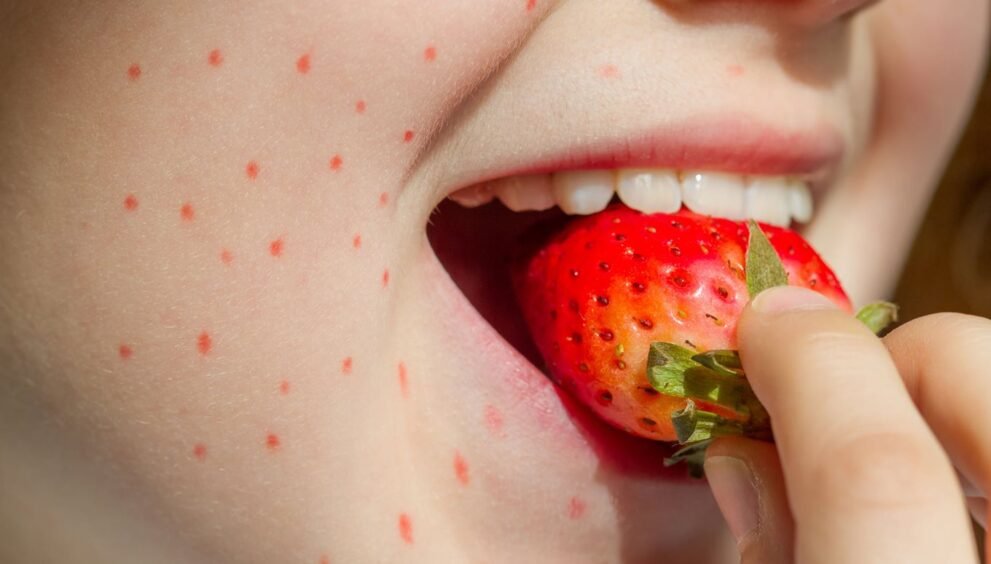 strawberry allergy