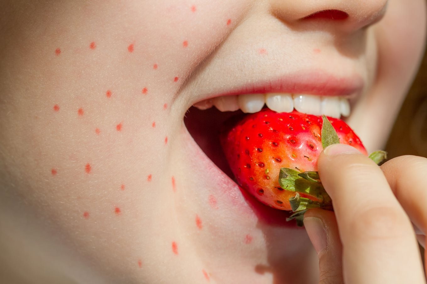 strawberry allergy