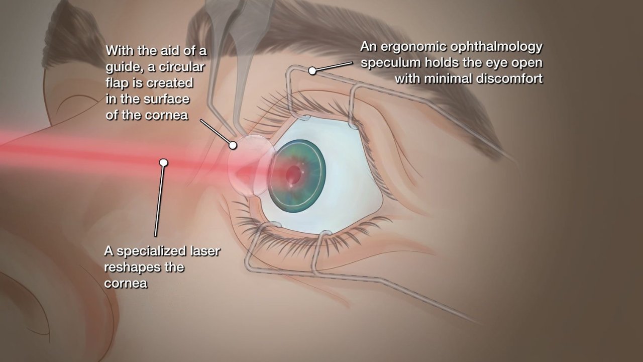 how long does laser eye surgery take