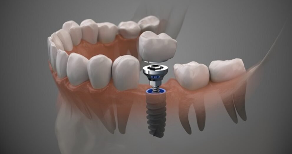 implant crowns