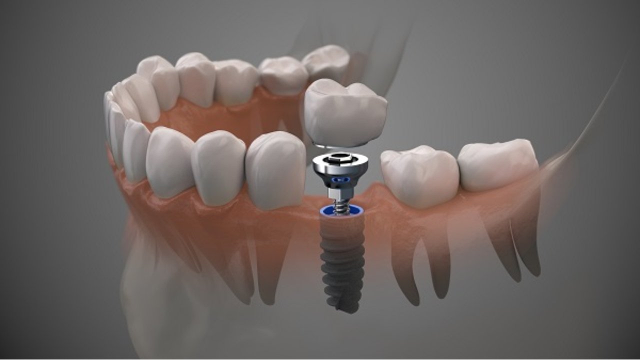 implant crowns