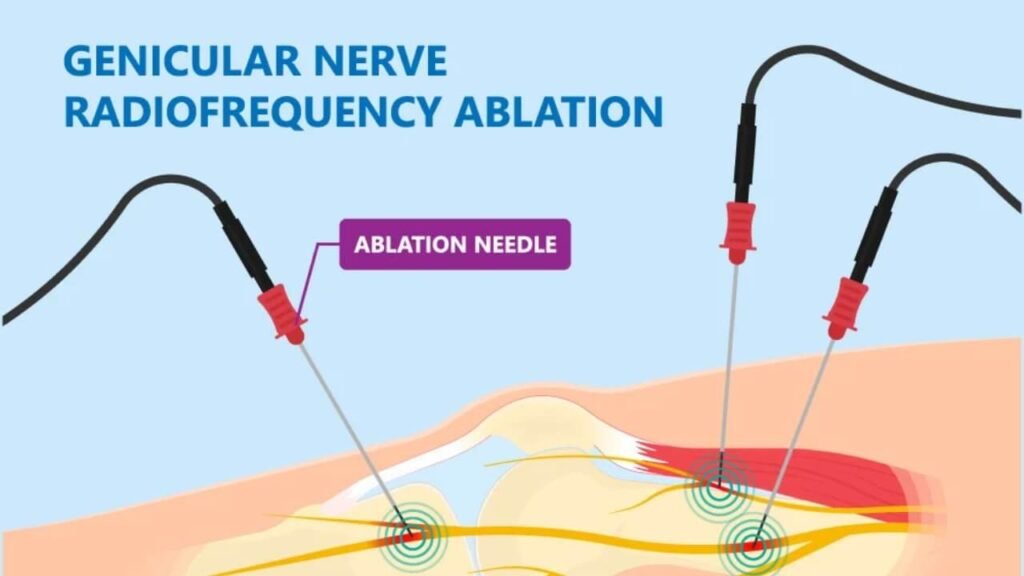 how long will a nerve block last