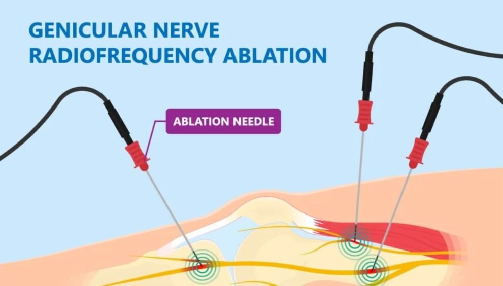 how long will a nerve block last