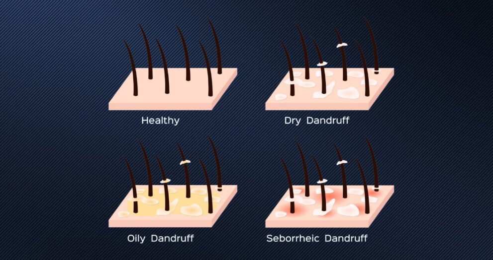 dandruff cause hair loss