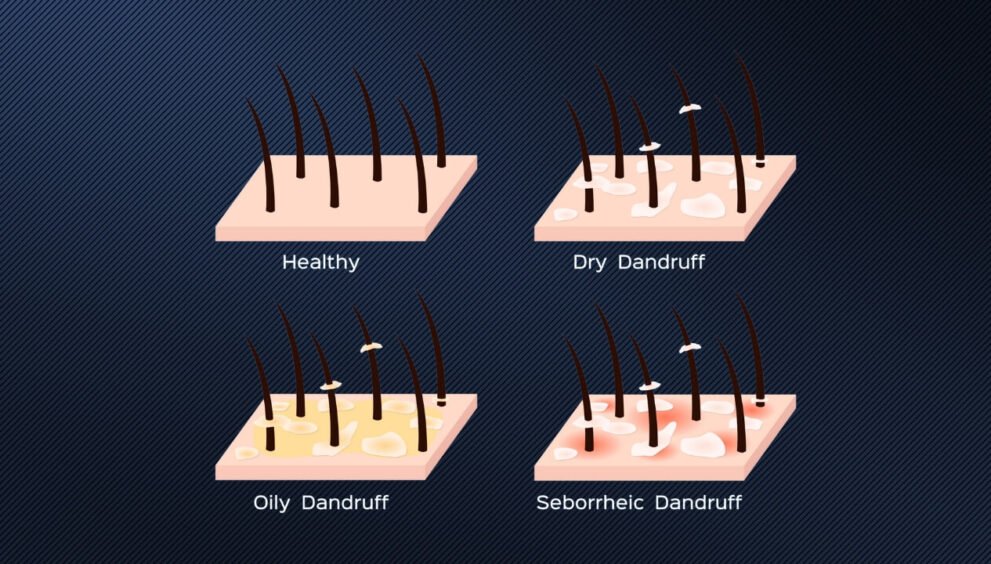 dandruff cause hair loss