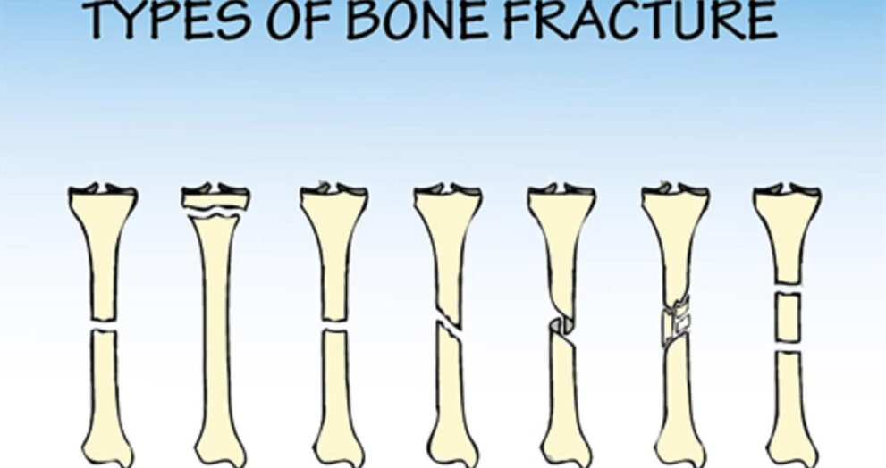 break versus fracture