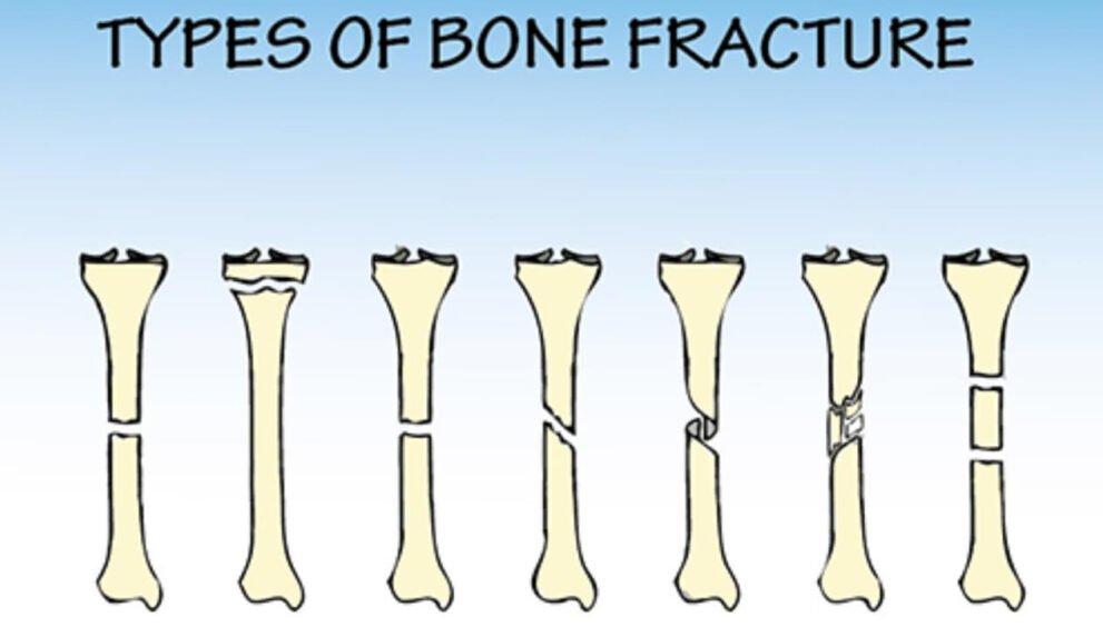 break versus fracture