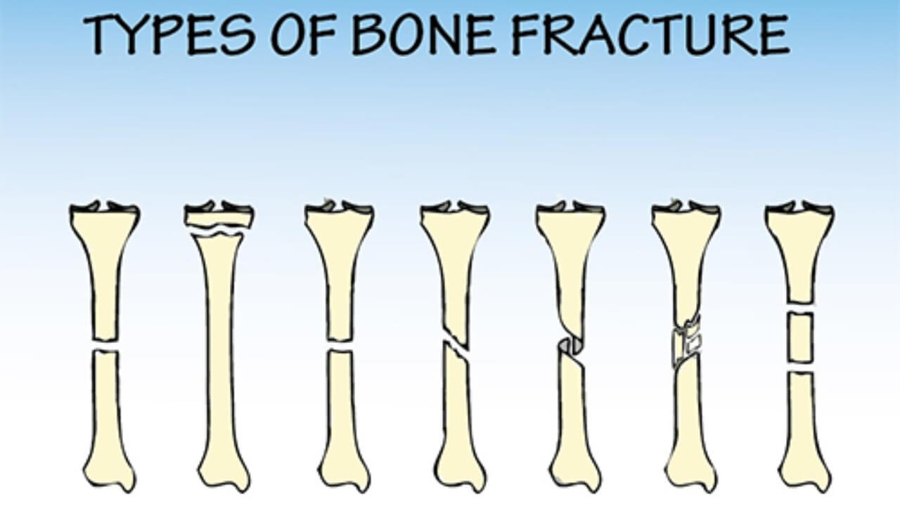 break versus fracture