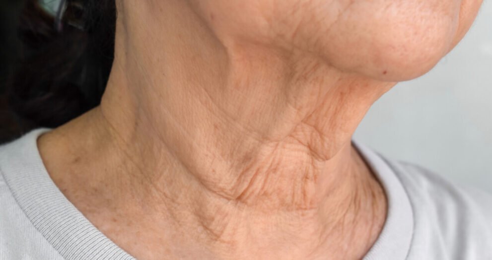 how to get rid of neck wrinkles