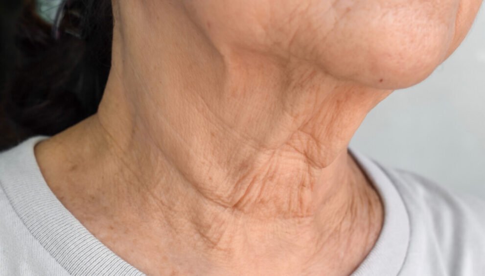 how to get rid of neck wrinkles